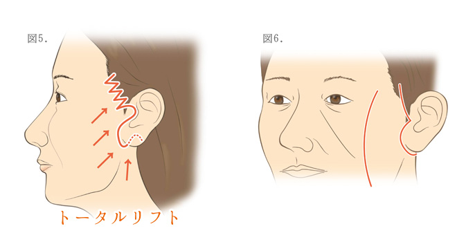 顔のしわとり
