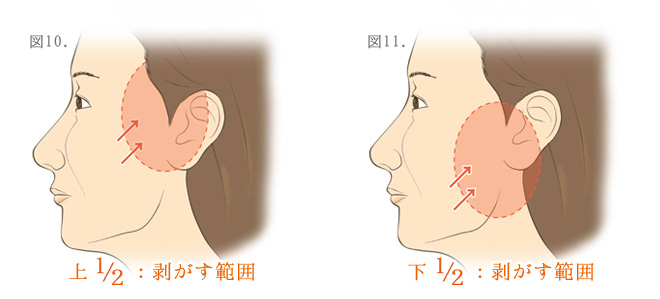 顔のしわとり