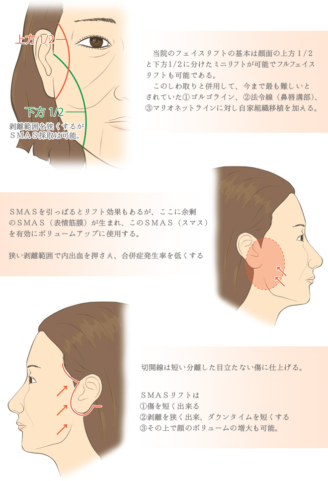 顔のしわとり