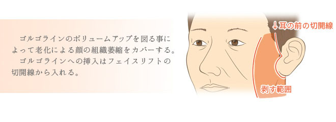 顔のしわとり