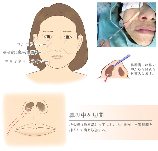 顔のしわとり