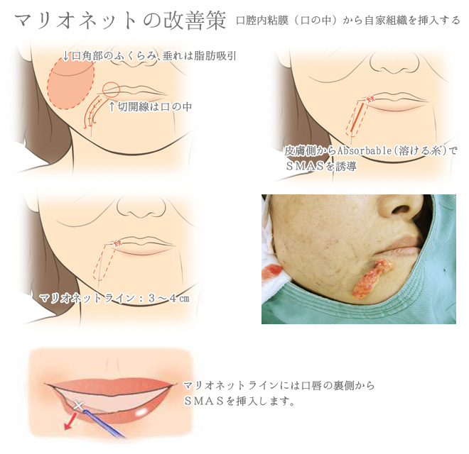 顔のしわとり